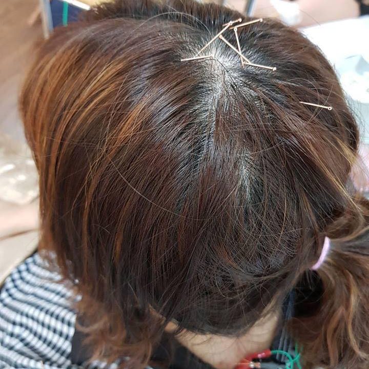 ลูกค้าที่มา ฝังเข็ม กับคุณหมอทรงพล (7)