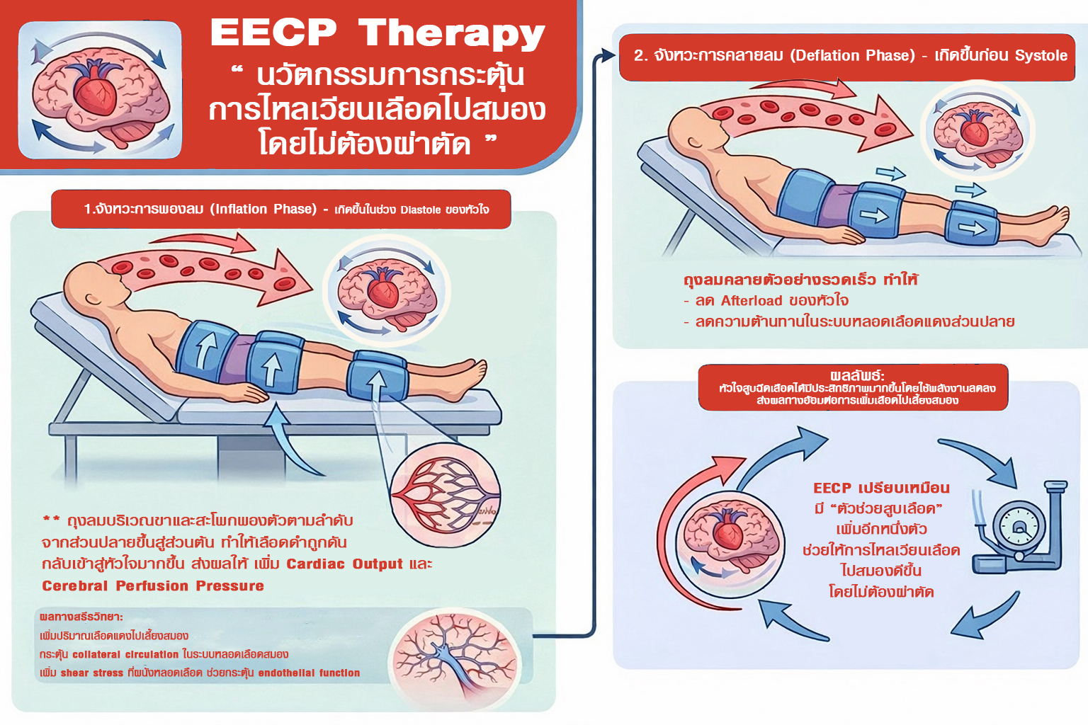 EECP การเพิ่มประสิทธิภาพการไหลเวียนเลือดไปยังสมองโดยแรงกดจากภายนอก